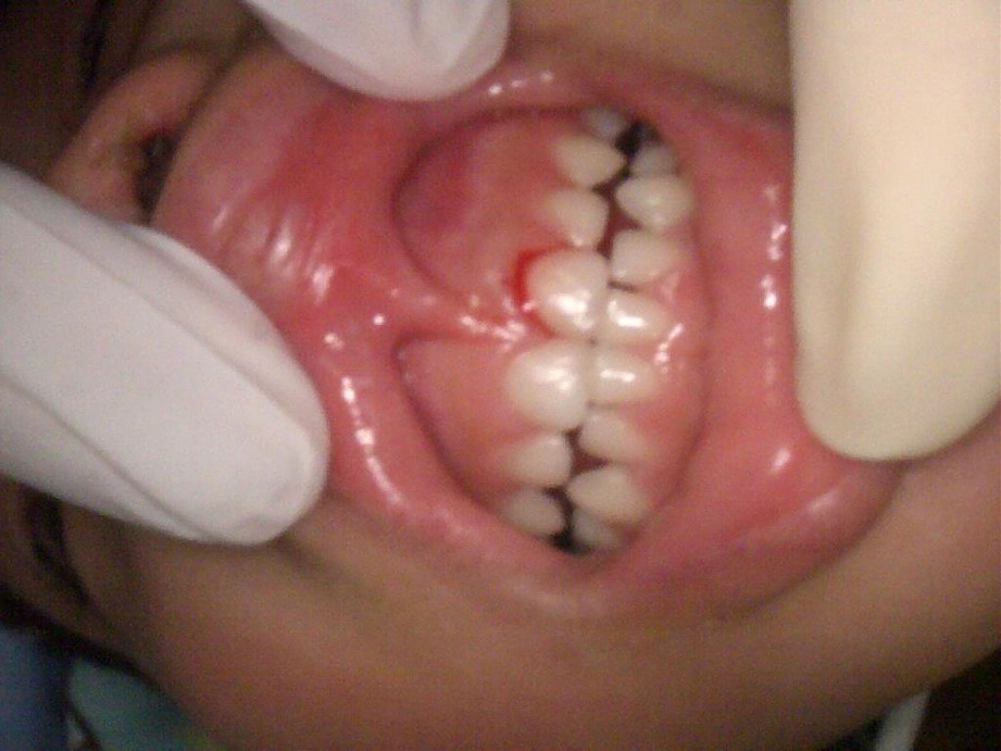 前歯の外傷
